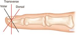 InService Insights: Fingertip amputations