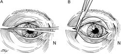 Consult Corner: Orbital floor fracture